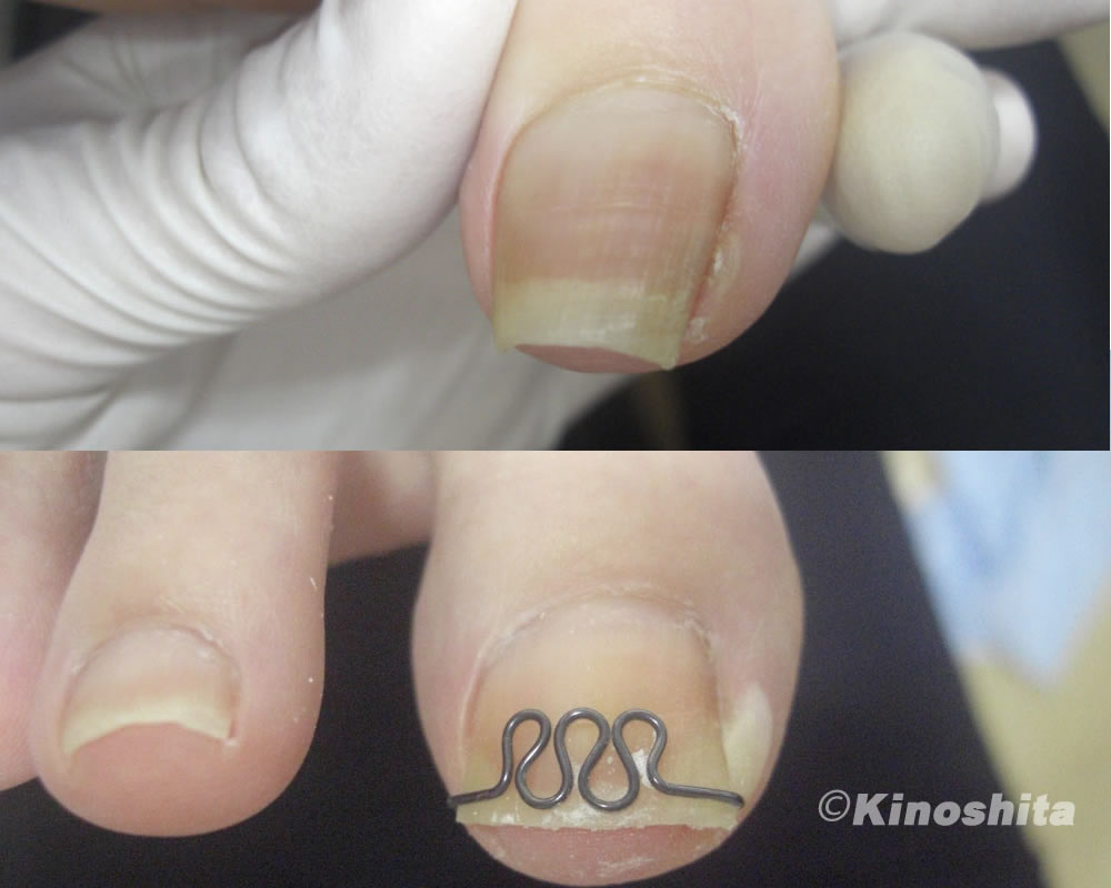 ツメフラ施術