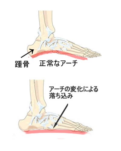 アーチの変化による落ち込み