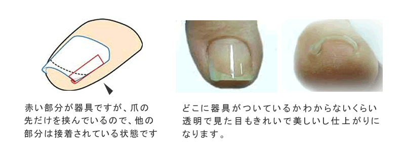 痛みもなく、美しい仕上がり